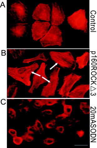 Figure 2 Changes in actin stress fibers and morphology in Caov-3 cells by expression of p160ROCKΔ3 mutant or ASODN against p160ROCK. A, control (transfectants with p160ROCK SODN, pCAG-myc vector and LipofectAMIN2000 show similar phenotypes). B, Caov-3 cells transfected with p160ROCKΔ3 construct. Arrows indicate brightly stained, longitudinal actin bundles formed in the cells. C, Caov-3 cells transfected with ASODN against p160ROCK (20 μ M). Cells were cultured for 48 h after transfection and subsequently stained for actin with rhodamine-phalloidin. Cells were examined under fluorescence microscope with ×400 magnification. Scale bar = 20 μ m.
