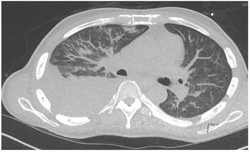 Figure 3. High-resolution CT chest above showing diffuse ground-glass opacity in the lungs and bilateral pleural effusion