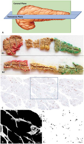 Figure 1. (A) Animated picture showing the method of grossing in coronal and transverse plane. (B) Photograph of entire coronal (B1) and transverse (B2) tissue section of head, body and tail taken from single pancreas. Colors were used for identification. (C) A single representative whole slide image of IHC, stained by anti-synaptophysin antibody; (D) Measuring tissue area of the image; (E) DAB positive areas (Islets) separated by ImageJ for analysis of islet area and diameter.