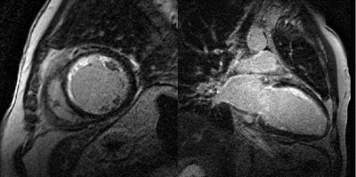 Figure 2. Delayed Enhancement images from the same patient reflecting irreversible injury in the sub-endocardial region of the anterior wall in the short axis (left) and the 2-chamber long axis view (right).