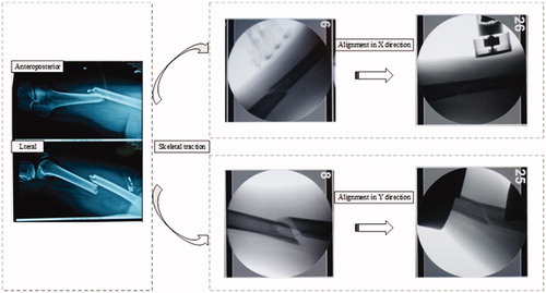 Figure 5. Intraoperative force–torque measurements.