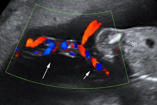 Figure 3 Cord entanglement in monoamniotic twin reversed arterial perfusion (TRAP) sequence at 18 weeks. Long arrow: entangled cords. Short arrow: segment of free cord. Asterisk: normal twin. Reproduced with permission from Prefumo F, Fichera A, Zanardini C, Frusca T. Fetoscopic cord transection for treatment of monoamniotic twin reversed arterial perfusion sequence. Ultrasound Obstet Gynecol. 2014;43(2):234–235. Copyright © 2013 ISUOG. Published by John Wiley & Sons Ltd.Citation52