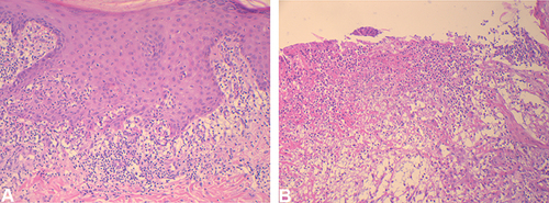 Figure 2 (A) an epidermal acanthosis and a lichenoid lymphocyte infiltrate in the superficial dermis with dermal edema (the papulovesicle on the abdomen, HE, ×100), (B) a dense polymorphic inflammatory dermal infiltrate, very rich in neutrophils (the ulcer on the calf, HE, ×100).
