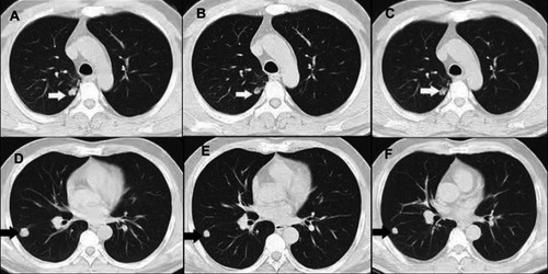 Figure 2 Chest CT scans before and after anlotinib treatment. (A and D): Before anlotinib treatment, two measurable tumor lesions were shown. (B and E) After two cycles of anlotinib treatment, a Partial response was observed. (C and F) After six cycles of anlotinib treatment, a continued partial response was observed. The white and black arrowheads aim at two measurable tumor lesions, respectively. Response assessment was based on RECIST guideline version 1.1.