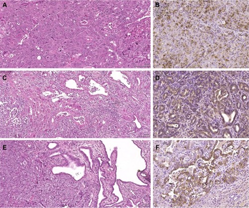 Figure 5 Histology and immunohistochemistry of tumors.