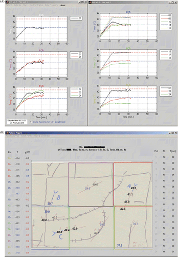 Figure 4. Screenshot of the temperature monitoring graphical user interface. (A) Temperature–time graphs for the sensors below each applicator are shown. (B) The measured temperatures are mapped onto a sketch that includes anatomical features, the location of the tumour and scar tissue, apertures of the applicators, catheter tracks and margins of the radiation field. For each measurement point the tissue type, depth, temperature and temperature difference over 20 s is also shown.