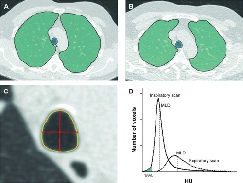 Figure 1 Illustration of the lung segmentation process and calculation of emphysema, air trapping, and TI.Notes: (A) Axial inspiratory CT image. (B) Axial expiratory CT image. Both (A and B) show lung segmentation (outlined green area) of the right and left lung on an axial slice. The trachea was segmented as well. (C) Magnified image of the trachea as shown in (A). TI is computed as follows. First, the centroid of the trachea is computed. Then, two orthogonal axes (0° and 90°) are drawn that cross the centroid (red lines). TI is computed as the ratio of the coronal and sagittal lines. (D) Graph showing attenuation histograms for the inspiratory and expiratory CT. The 15th percentile (measure for emphysema) is calculated as the HU point below which 15% of the voxels are distributed. Air trapping is calculated as the ratio of MLD on the expiratory and inspiratory images.Abbreviations: CT, computed tomography; HU, Hounsfield Unit; MLD, mean lung density; TI, tracheal index.