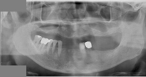 Figure 13 Ten-year post-treatment orthopantomogram.