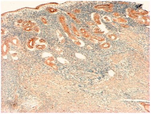 Figure 1. Immunohistochemistry analysis expression of VEGF in the endometrium and myometrium at adenomyosis. IHC MAT to VEGF, original magnification  80×.