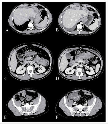 Figure 1. Computerized axial tomography (CAT) scans. Baseline CT-scan (A, C, E) compared with that performed after two cycles of chemotherapy (B, D, F) shows a significant gastric, peritoneal and hepatic progression.