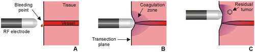 Figure 1. Sealing mechanism of an RF electrode used as hemostatic device during surgery. The electrode is placed on the bleeding point (A) and the applied RF current creates a coagulation zone that involves shrinkage of the tissue and vessel sealing (B). In the context of surgical oncology, RF-based hemostatic devices can also be used to ablate the surface of the remnant organ to increase the tumor-free margin and minimize local recurrence (C).