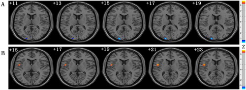 Figure 4. Clusters with significantly altered mReHo values among groups. (A) The blue-yellow areas denote lower mReHo values in the MHD-CI group than in the HC group. (B) The red-yellow areas denote higher mfALFF values in the MHD-CI group than in the HC group. mReHo: mean regional concordance; MHD-CI: maintenance hemodialysis patients with cognitive impairment; MHD-NCI: maintenance hemodialysis patients without cognitive impairment; HC: healthy controls.