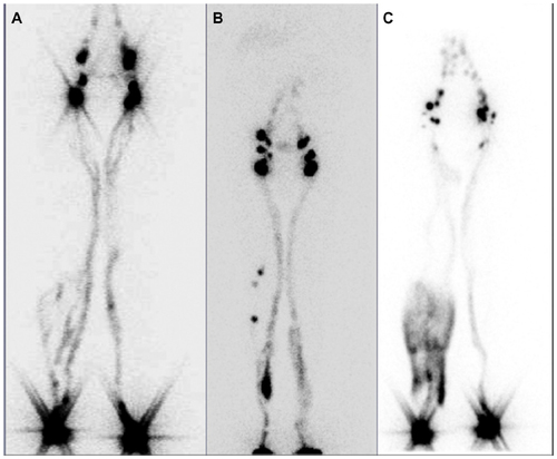Figure 1 Lower limb lymphoscintigraphy.