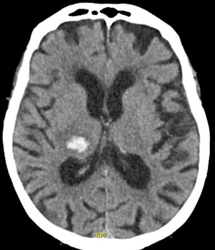 Figure 1 Cranial CT scan upon arrival to the emergency department.