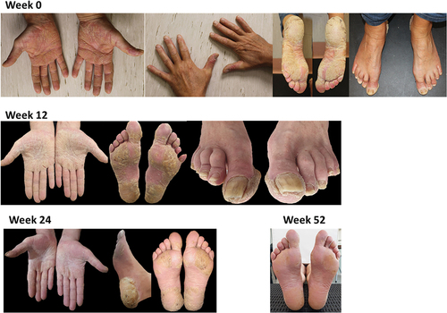 Figure 3. Changes in psoriasis skin lesions during treatment with secukinumab: case 2.