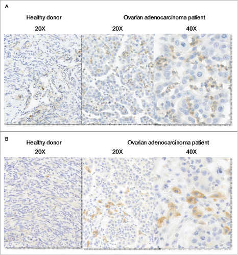 Figure 4. IL-27 is expressed by tumor-infiltrating neutrophils in vicinity of CD163+ macrophages. Immunochemical analysis of IL-27 (A) and CD163 (B) in normal tissue (left panel) and in ovarian adenocarcinomas (right panels).
