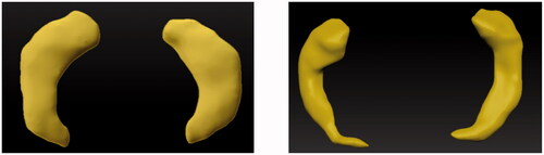 Figure 16. The PolyPainted 3D models to be exported into the digital model. The healthy hippocampus (left) and the atrophied AD hippocampus (right).