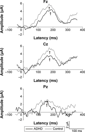 Figure 1 Mismatch negativity (MMN) grand-average waveforms from children and adolescents with attention deficit/hyperactivity disorder (ADHD) and healthy controls.