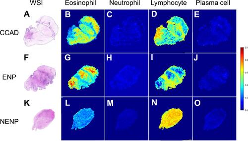 Figure 5 Cellular endotypes of CCAD, ENP, and NENP based on the WSI. (A-E) Representative photomicrographs of hematoxylin-eosin staining and heatmaps of eosinophil, neutrophil, lymphocyte and plasma cell in CCAD. (F-J) Representative photomicrographs of hematoxylin-eosin staining and heatmaps of eosinophil, neutrophil, lymphocyte and plasma cell in ENP. (K-O) Representative photomicrographs of hematoxylin-eosin staining and heatmaps of eosinophil, neutrophil, lymphocyte and plasma cell in NENP.