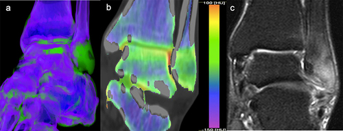 Figure 3 Patient with bone marrow edema at the distal fibula. (a) Volume rendering of dual-energy CT with bone marrow color coding. (b) Coronal reconstructions coding of dual-energy CT with bone marrow color coding. (c) Corresponding short tau inversion recovery MRI sequence. Although visible on dual-energy CT, the bone marrow edema is still best depicted on MRI.