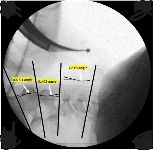 Figure 3. Lateral fluoroscopic cervical X-ray image during intubation with D blade.