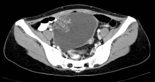 Figure 2.  CT pelvis showing the left sided teratoma in Patient 2