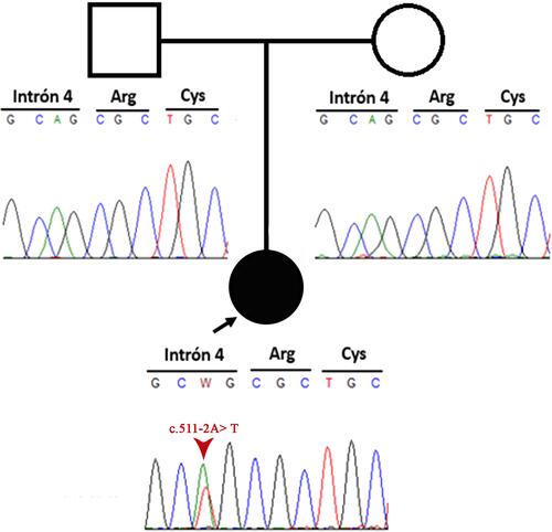 Figure 2 Pedigree information of the patient and Sanger sequencing electropherogram of both patient and her parents. The image shows a de novo mutation.