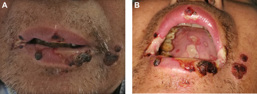 Figure 1 Clinical manifestations of the perioral area (A) and the oral mucosa tissue (B) infected due to non-O1/non-O139 V. cholerae.