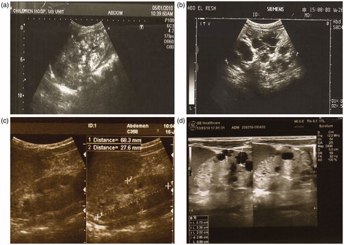 Figure 1. Renal ultrasound scans of: (a) Ten-month-old boy, autosomal recessive polycystic kidney disease: enlarged hyperechoic solitary kidney with poor corticomedullary differentiation and multiple scattered tiny cysts. The arrow points to hypoechoic cortical rim devoid of renal cysts. (b) Fifteen-year-old girl, autosomal dominant polycystic kidney disease: enlarged kidney with multiple variable-sized cysts scattered all through the renal parenchyma. (c) Six-year-old girl, juvenile nephronophthisis: normal-sized hyperechoic kidneys with multiple small corticomedullary cysts. (d) Three-month-old girl, bilateral cystic renal dysplasia: small-sized hyperechoic kidneys with poor corticomedullary differentiation and multiple variable-sized scattered cysts; some are cortical and subcapsular.
