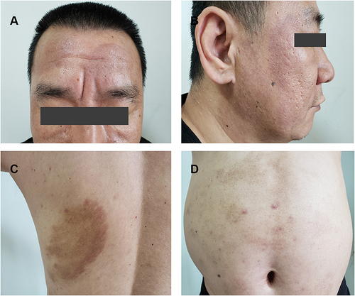Figure 3 Resolution of lesions. The lesions on the face (A and B), abdomen (C) and back (D) subsided, leaving behind pigmentation.