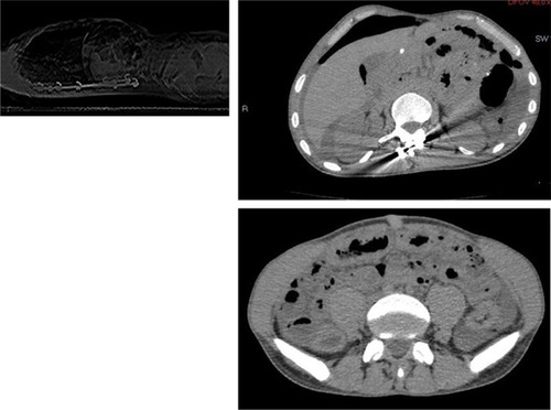 Figure 1 Computerized tomography scan showing the presence of marked pneumoperitoneum and discreet intra-abdominal free fluid, more evident in the upper quadrants, with air–fluid level in the right upper quadrant.