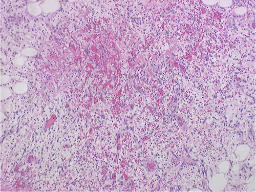 Fig. 3 Hematoxylin and eosin staining of colonic biopsy specimen showing acute and chronic inflammation.
