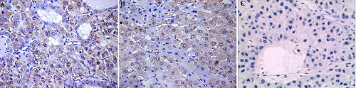 Figure 1 Expression of MIF. (A) Positive expression of MIF in HCC×200. (B) Positive expression of MIF in HBV-LC×200. (C) Negative expression of MIF in normal liver tissue×200.