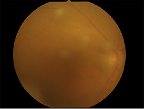 Figure 3 String of pearls OCV in right eye.