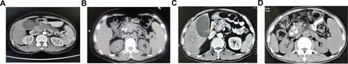 Figure 2 CT images of the combined group and the SEMS-CL-125I group preoperatively and 3 months postoperatively. (A and B) CT comparison between preoperative and postoperative reexaminations at 3 months in the SEMS-CL-125I group. (C and D) CT comparison between preoperative and postoperative review at 3 months in the combined group (white and red arrows indicate the location of the tumor).