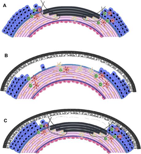 Figure 2 Schematic depicting potential applications and orientation of AMT (depicted in grey) on the ocular surface. (A) Inlay (graft) amnion transplantation. Epithelial-side-up: amnion replaces lost stromal tissue, up to the basement membrane. (B) Onlay (patch) transplantation where amnion is placed epithelial-side-down over the wound periphery as a temporary biological dressing. (C) Combinatorial/Sandwich AMT.