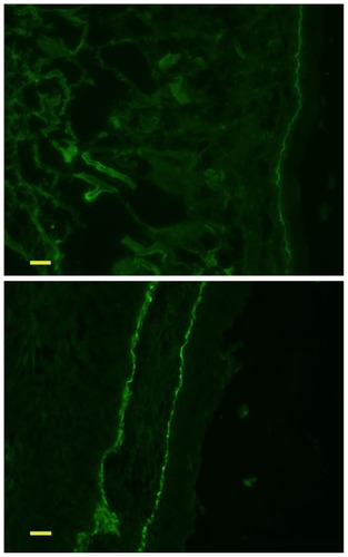 Figure 2 Digital photomicrographs of the conjunctival biopsy, showing immunoglobulin G4 deposits in the basement membrane zone.