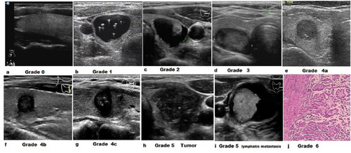 Figure 1 The classification standard for modified TI-RADS system. (A) Grade 0 by improved TI-RADS system; (B) Grade 1 by improved TI-RADS system; (C), Grade 2 by improved TI-RADS system; (D) Grade 3 by improved TI-RADS system; (E) Grade 4a by improved TI-RADS system; (F) Grade 4b by improved TI-RADS system; (G) Grade 4c by improved TI-RADS system; (H) Thyroid nodules, Grade 5 by improved TI-RADS system; (I and H) Lymphatic metastasis, Grade 5 by improved TI-RADS system; (J) Thyroid papillary cancer under microscope by 400×, Grade 6 by improved TI-RADS system.