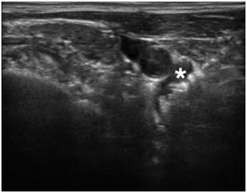 Figure 3. Characteristic ‘bubbles’ around the bRFA-probe indicating a thermal process. (* = Adenoma).