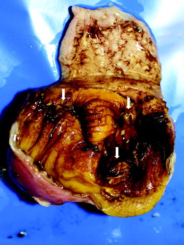 Figure 1. Gross lesions in gizzards from 41-day-old pullets (pullet flock P-A). Erosions in the koilin layer (arrows).