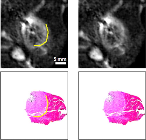 Figure 3. Comparison of the cell-death boundary identified in histology with the MR image features. The registered images at left and right are identical except for graphical overlays on the left-hand images showing the cell-death boundary (in yellow). The upper images are in vivo T2-weighted MR lesion images; the lower pair are Masson trichrome-stained histology images. The boundary corresponds to a region of decreased stain uptake and a loss of the muscle's birefringence. The boundary is marked on the histology image with a graphical overlay and copied to the registered MR image, where it matches the outer boundary of the hyperintense region in the MR image. Other white regions in the MR images are streaks of fat and the elliptical femur bone in the lower left corner. The figure is reproduced in colour in the online issue of Computer Aided Surgery.