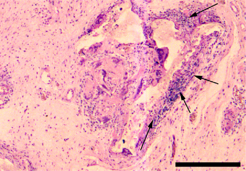 Figure S2 Lymphocytic infiltration at the implantation site of the PL-SF acellular scaffold. Notes: Infiltration is pointed by black solid arrows. Scale bar, 500 μm.Abbreviation: PL-SF, poly-l-lactide/silk fibroin.