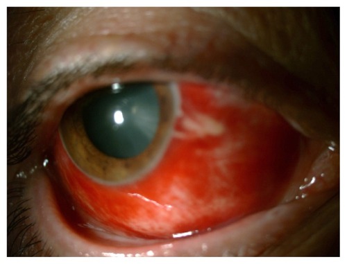 Figure 1 This patient with diffuse subconjunctival hemorrhage had uncontrolled hypertension.