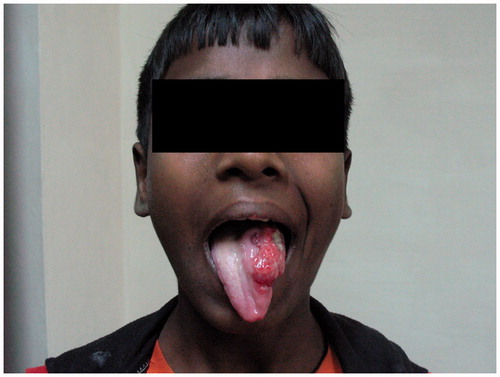 Figure 1. Preoperative ulceroproliferative growth measuring about 5 × 4 cm2 at left lateral border of tongue.