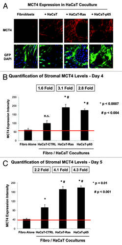 Figure 6. Ras oncogene activation and inflammation drive the upregulation of MCT4 expression in adjacent cancer-associated fibroblasts. (A) HaCaT epithelial cells (control, H-Ras [G12V], or NFkB [p65]) were co-cultured for 4 days with hTERT-immortalized fibroblasts (GFP+). Then, the cells were fixed and immunostained with specific antibody probes. Note that MCT4 expression is increased most significantly in fibroblasts co-cultured with HaCaT-Ras and HaCaT-p65 cells. In contrast, HaCaT control cells only induced a mild or modest increase in stromal MCT4 expression. DAPI (blue nuclear staining) is also shown for reference. (B) Image quantitation regarding the oncogene-induced upregulation of stromal MCT4 at day 4 is presented; note that there is a significant 3-fold upregulation of MCT4 expression. P values vs. fibroblasts alone (P < 0.0007) and vs. HaCaT-CTRL co-cultures (P < 0.004) are both shown. (C) Image quantitation regarding the oncogene-induced upregulation of stromal MCT4 at day 5 is presented; note that there is a significant 4-fold upregulation of MCT4 expression. P values vs. fibroblasts alone (P < 0.01) and vs. HaCaT-CTRL co-cultures (P < 0.001) are both shown.