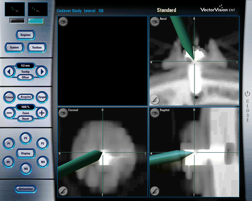 Figure 3. Navigational screenshot. Titanium screws served as target points and were aimed at by the referenced infrared pointer of the navigation system. The distance between the target point and the tip of the pointer was measured separately for each of the three planes (axial, coronal, sagittal) using the scale on the navigation screen.