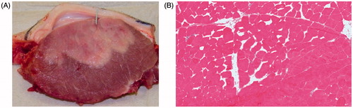 Figure 1. Qualitative comparison of macroscopic (A) and microscopic (B) thermal damage. Note the sharp transition from damaged tissue (pale area in A) to normal tissue (dark/red area in A). In A, the temperature probe is positioned within the pale damaged tissue. The damage turns out to be severe in nature, characterised by burn blister, which separates subcutaneous fat from muscle. In B, the frozen section stained with H&E shows a sharp interface between the normal muscle tissue in the lower right part of the picture and the widening of the extracellular space in the thermally damaged upper left part of the picture.