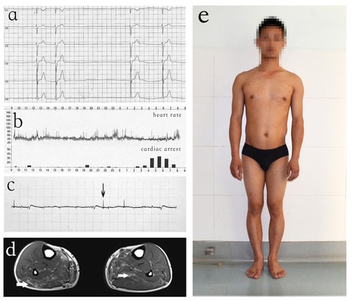 Figure 1 Clinical characteristics of proband (V-4). (A) ECG showed sinus bradycardia and occasional sinus cardiac arrest. (B) 24 hr ambulatory electrocardiogram showed the changes in heart rate and sinus cardiac arrest in a day. (C) EMG displayed spontaneous electromyographic activity in limb muscles. (D) Muscular MRI showed mild fatty infiltration in the skeletal muscle. (E) The patient (proband) developed without any obvious symptoms of neuromuscular disease.