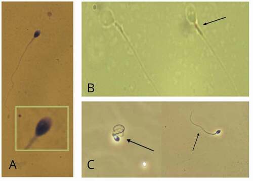 Figure 2. Representative photographs of mitochondrial activity, viability, and morphological defects of spermatozoa. A) Photograph of defective spermatozoa staining by deposition of DAB (3,3 diaminobenzidine) in the mitochondrial sheath along the middle part of the spermatozoon (black arrows). B) Photographs of spermatozoa viability assessed by the hypo-osmotic (HOS) test. In a hypo-osmotic environment viable spermatozoa with an intact membrane exhibit swelling of the tail curvature (right photograph) or a coiling of the tail (left photograph) due to water influx as shown for the cells circled. C) Example of abnormal human spermatozoa morphology according to WHO methodology, showing the presence of 2 vacuoles in the nucleus. All images courtesy of the Androscience laboratory (São Paulo, Brazil).