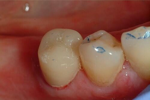 Figure 7 Intraoral photography after provisional composite resin crown cementation.